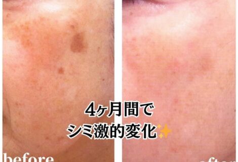 【徹底シミケア】長年のシミを諦めない！4ヵ月で劇的変化◎