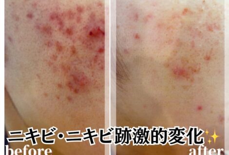 【フェイシャル】季節の変わり目＊春の美肌ケア