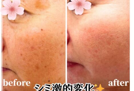 【シミケア】いまあるシミも諦めない！感動変化☆