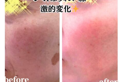 夏こそ！集中美容でリフレッシュ♪