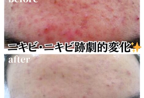 【光老化ケア】いまこそ集中ケアでお肌の機能を回復☆